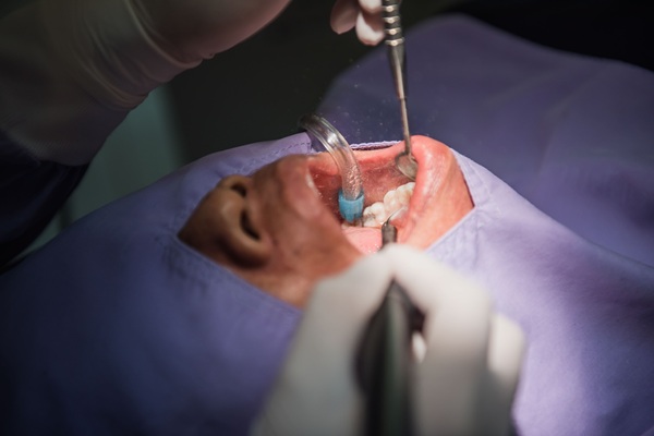The Importance Of Deep Cleaning For Gum Health And Long Term Oral Care