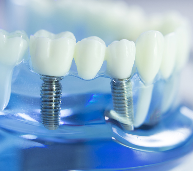 Palm Desert Dental Implants