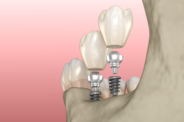 Same Day Implant Options With Mini Dental Implants