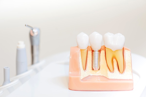 Traditional Dental Implants Vs  Mini Dental Implants: Which Is For You?