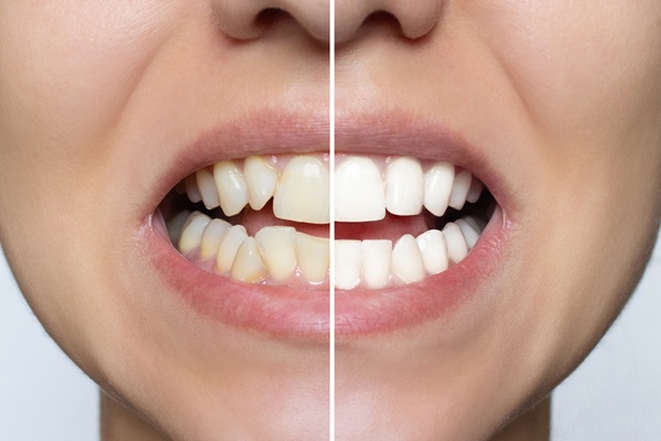 Teeth Whitening    : Your Guide To A Dazzling Smile